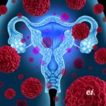 Le cancer du col de l’utérus